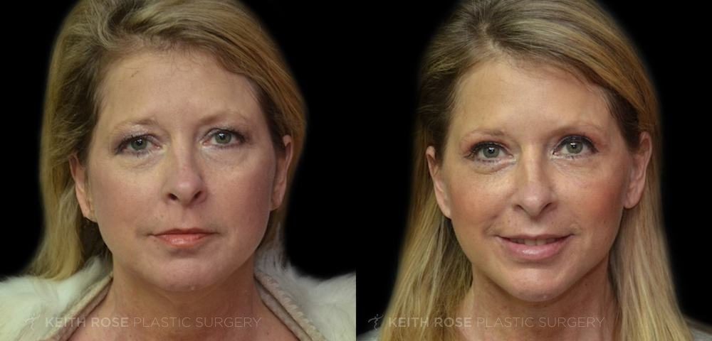 Facelift Before and After