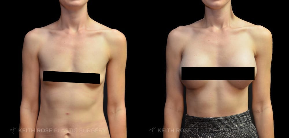 Before and After Breast Augmentation