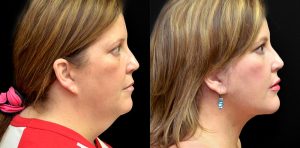 Patient 2 chin implants before and after j Keith rose md