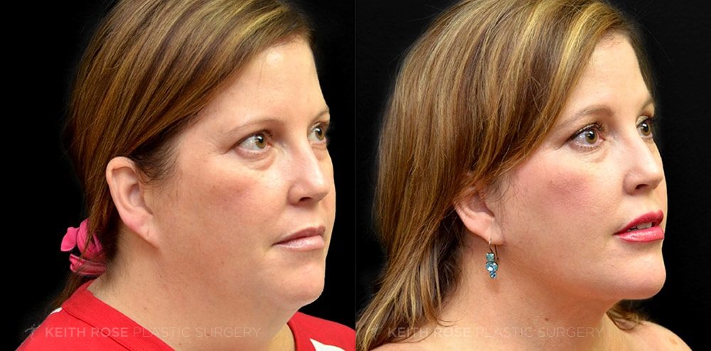 Patient 1 Chin Implants Before and After
