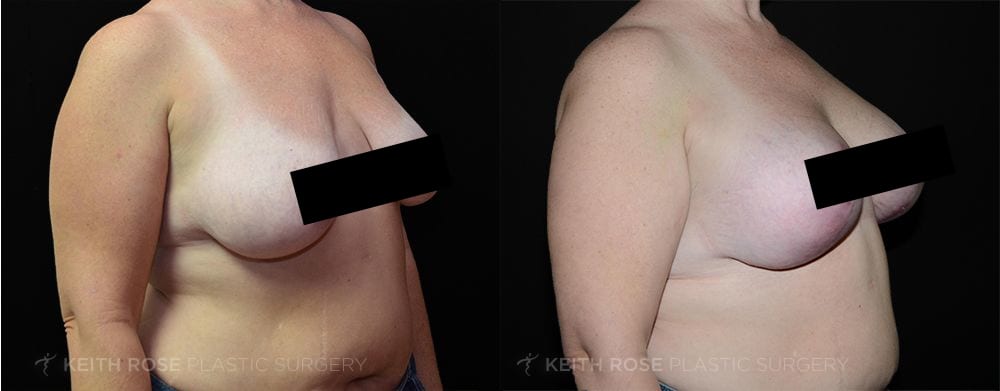 Breast Lift Before & After