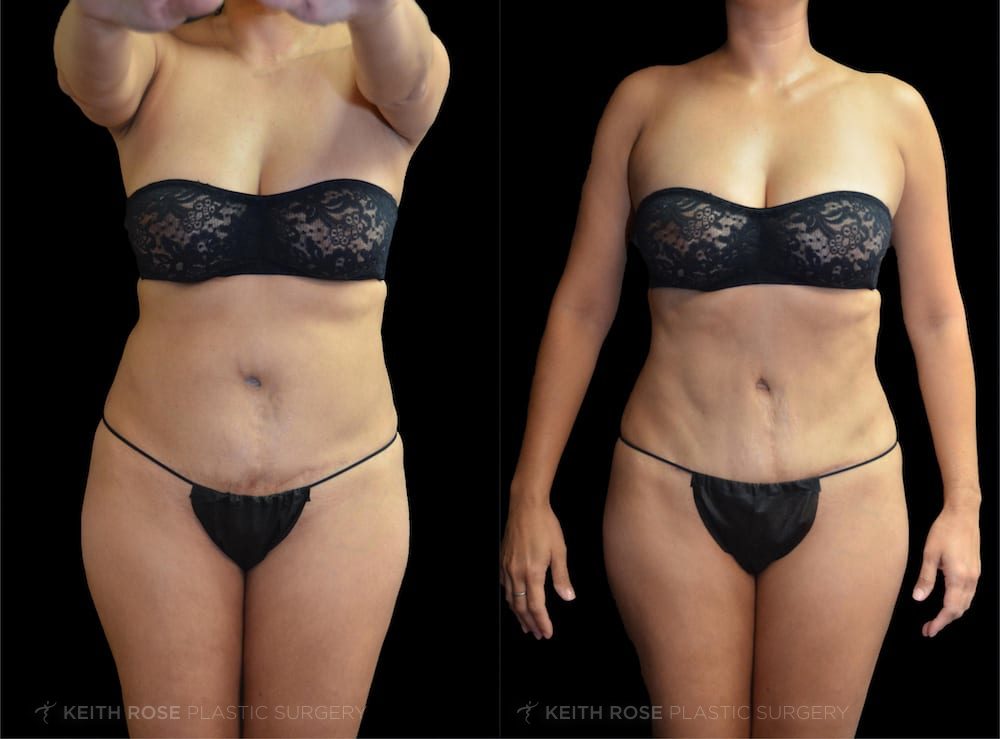 Before and After Liposuction