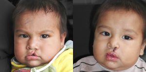 Patient 9 cleft lip before and after j Keith rose md