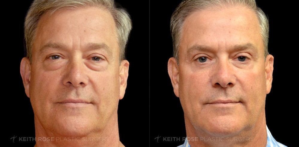 Before & After Brachioplasty