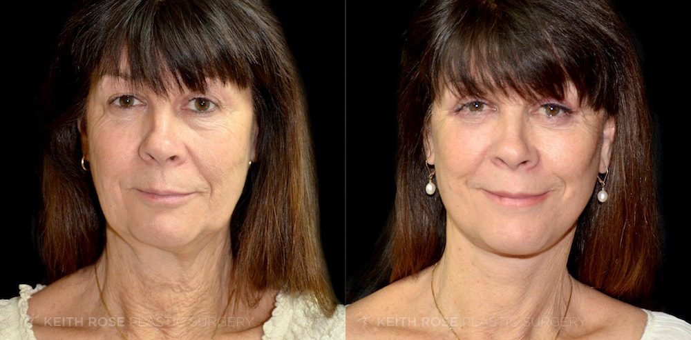 Patient 1 Facelift Before and After