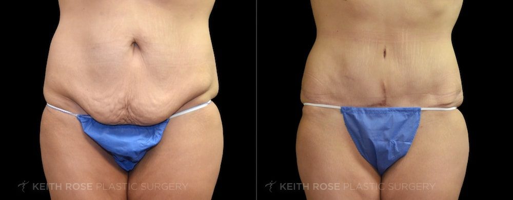 Patient 12 Tummy Tuck Before and After