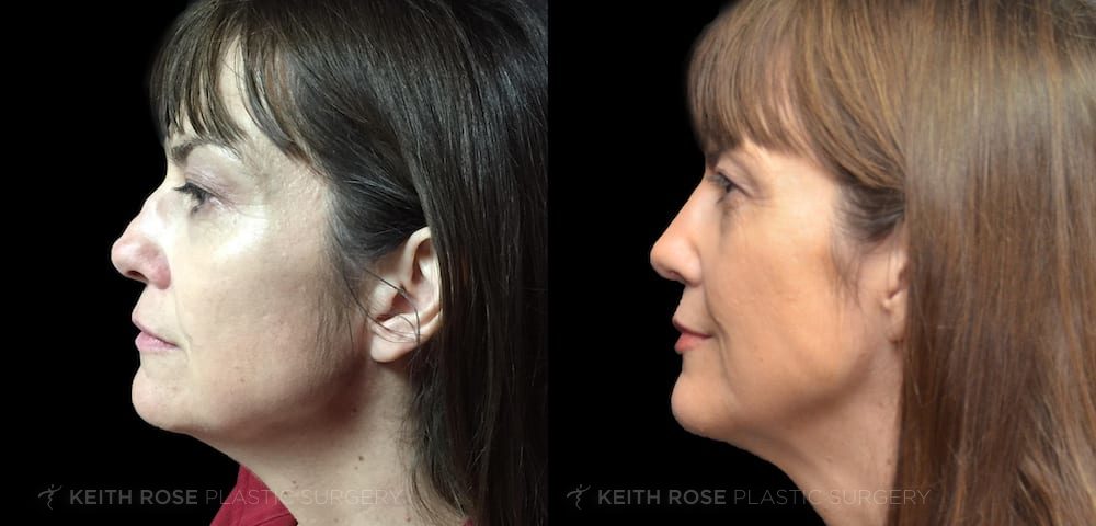 Rhinoplasty Patient 47: Before and After