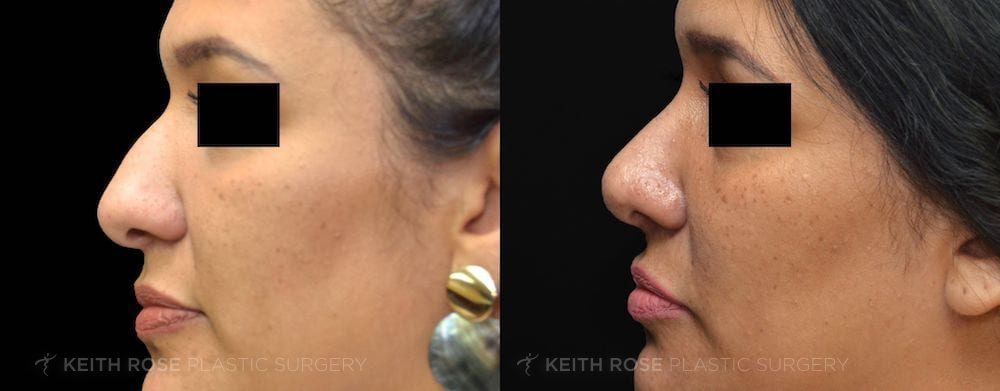 Rhinoplasty Patient 46 Before and After