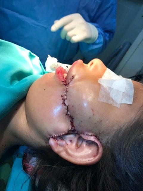 Child patient after facial surgery j Keith rose md