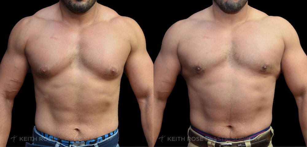 Increase in men with man boobs having breast reduction surgery