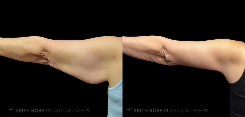 How An Arm May Look after an Arm Lift