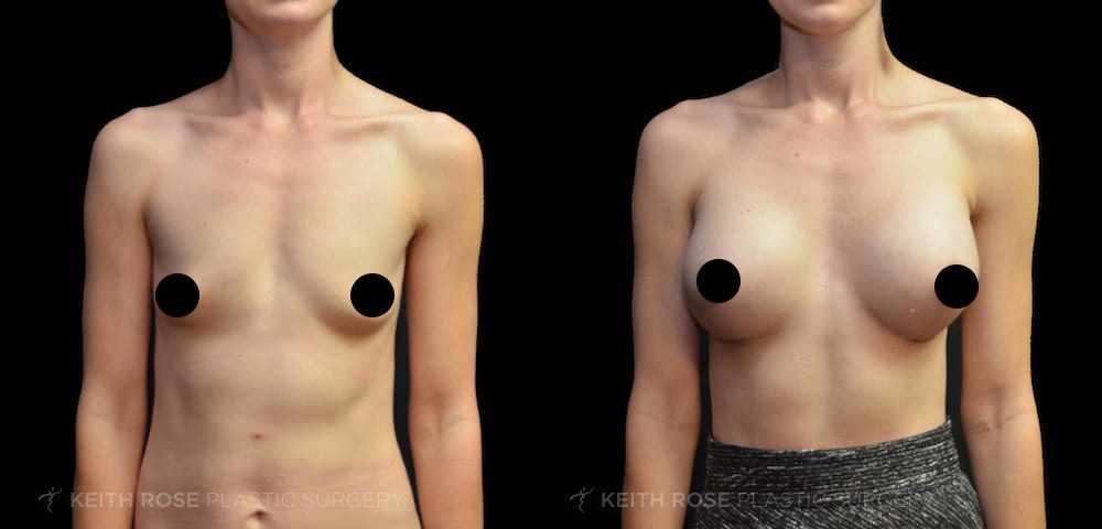 Breast Augmentation in Corpus Christi