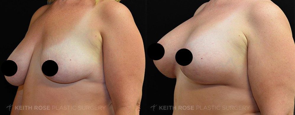 Breast Augmentation Before & After